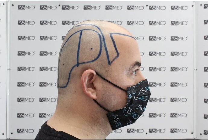 ASMED CLINIC - DR.KORAY - 5060 GRAFTS FUE photo