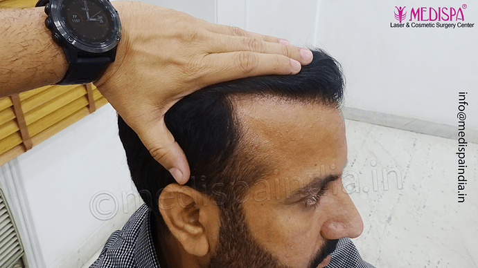 Dr. Suneet Soni - 5334 Grafts, Combine FUT + FUE + BHT (Beard) Technique, NW- V photo