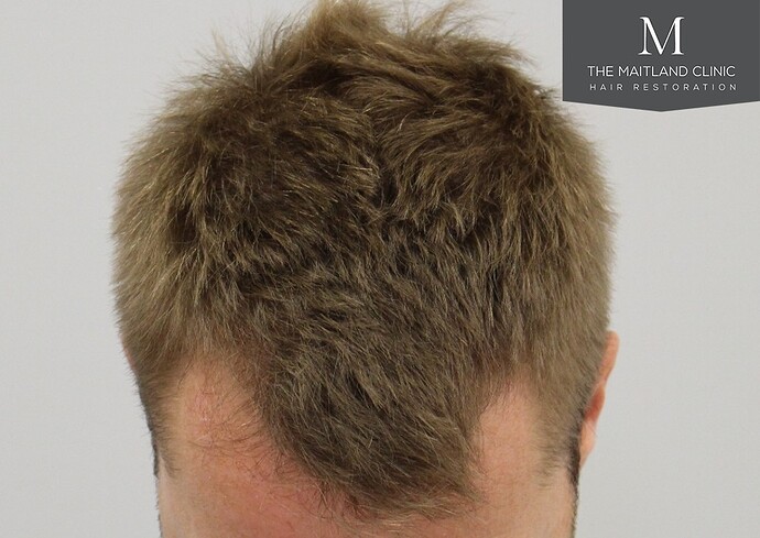 Dr Ball - The Maitland Clinic 1204 Grafts By FUE photo