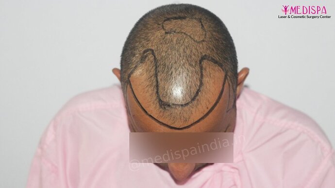 Dr. Suneet Soni - 4025 Grafts | 12-Month Result | Combination FUT + FUE photo
