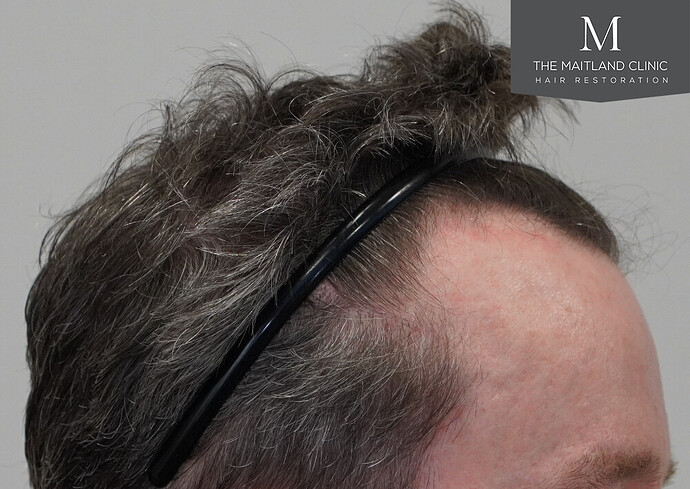 Before and after results: 1694 grafts by FUE at The Maitland Clinic (Dr Edward Maitland Ball) photo