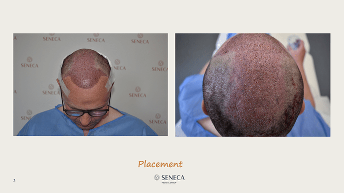 Seneca Medical Group - 3189 grafts with Direct Fue photo