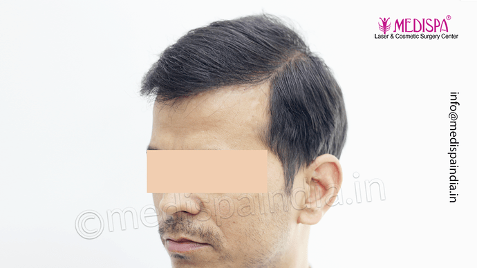 Dr. Suneet Soni - 4533 Grafts, Combine FUT + FUE Technique , NW-IV/V photo