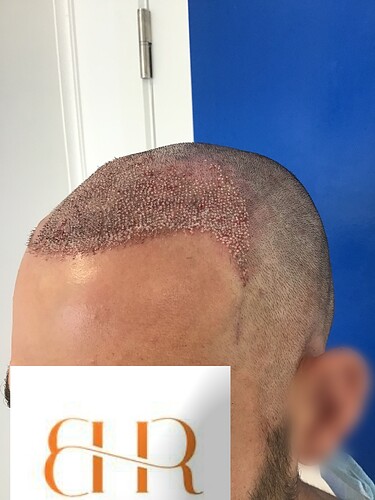 Dr. Bisanga & Dr. Kostis BHR Clinic - 3500 FUE 0 - 8 Months photo