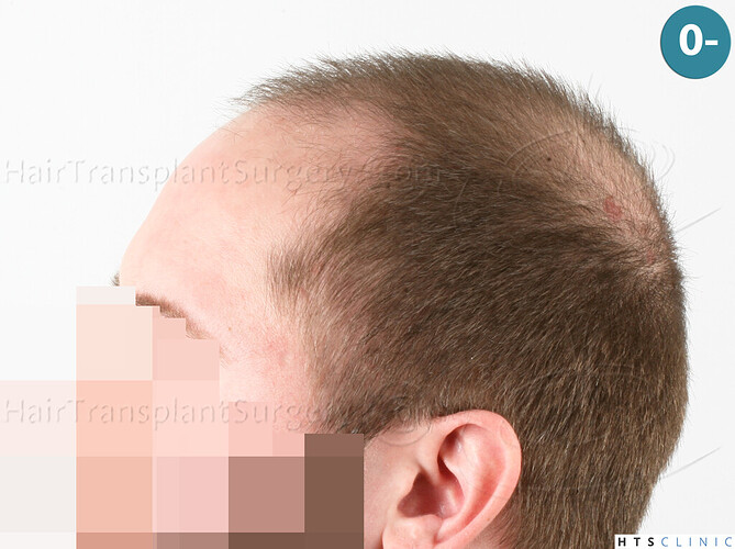 Dr. Jean Devroye, HTS Clinic / 3523 FUE / NW V, 1 session photo