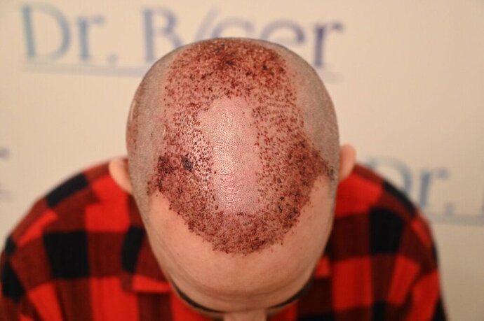 Ozlem Bicer MD-Hair Transplant-3870 Grafts FUE by micro-motor, 5. months result photo