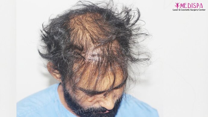 Revision Hair Transplant - 5111 Grafts / 5 Years Result - Dr. Suneet Soni, Medispa India photo