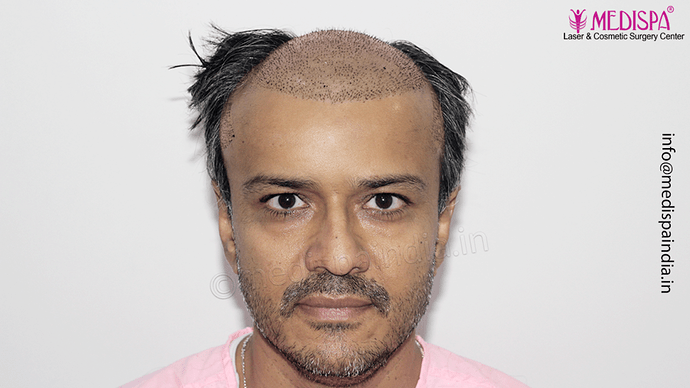 Dr. Suneet Soni - 4889 Grafts | 2.5 Years Result | Combination FUT + FUE + Beard photo
