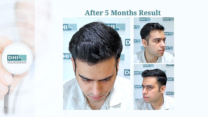DHI India™ | NW 3 | 1,504 Grafts | 5 Months DHI Hair Transplant Results photo