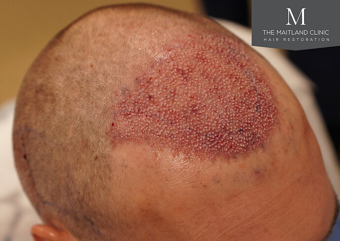 1826 grafts by FUE with Dr Edward Maitland Ball at The Maitland Clinic photo