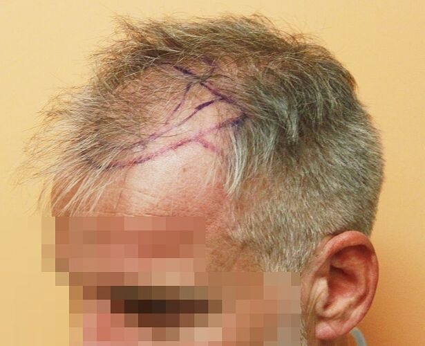 Dr. Bisanga - BHR Clinic / 3003 FUE - Frontal Case photo
