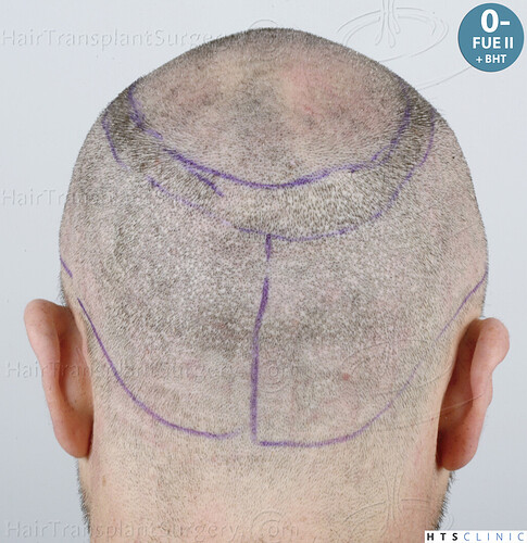 Dr. Jean Devroye, HTS Clinic / 5913 grafts (3036 FUE + 2877 FUE-BHT) / 2 sessions photo