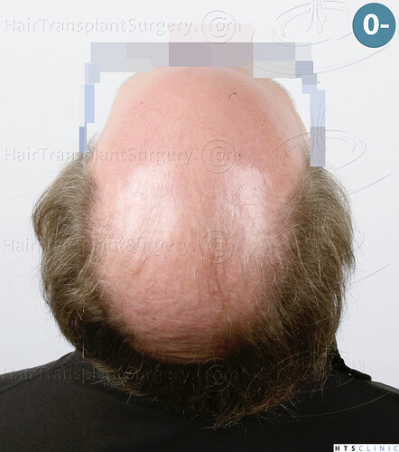 Dr. Jean Devroye, HTS Clinic / 6494 FUE-BHT (3150 + 3344) / NW VII, 2 sessions photo