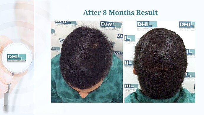 DHI India™ | Crowning Glory Restored | 2,650 Grafts | 8 Months Hair Transplant Result photo
