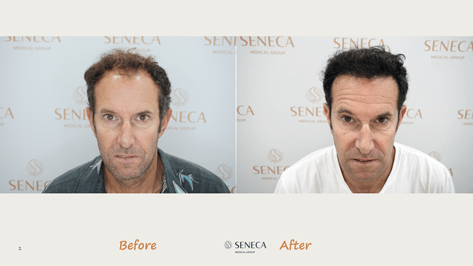 Seneca Medical Group - 1700 grafts with Direct Fue photo