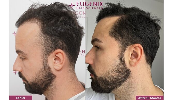 Dr. Somesh| Eugenix Hair Sciences Clinic | NW 3 | 3007 Grafts | 10 Months Post-op photo