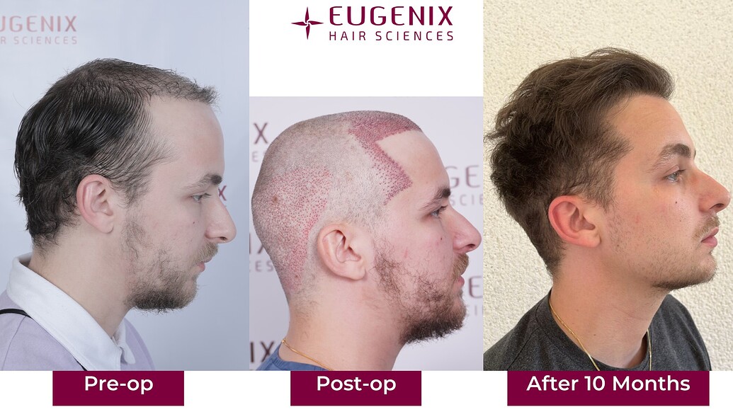 https://cdn.forumhairtransplant.com/optimized/3X/4/0/4026ca5fb0be742cce251de1334e6c98c6a92c49_2_1035x582.jpeg