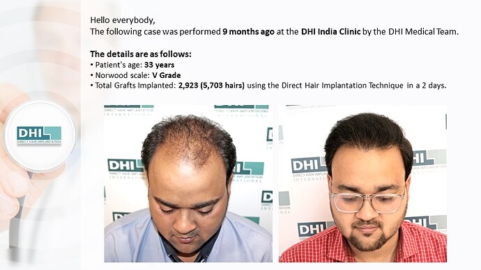 DHI India | NW Scale 5 | 2,923 Grafts | 9-Months DHI Hair Transplant Results photo