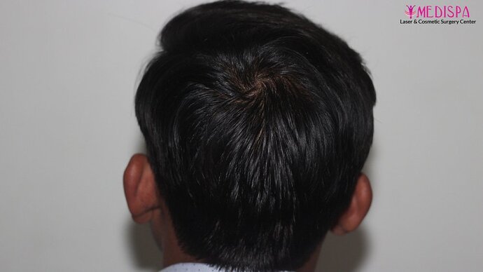 Dr. Suneet Soni - 5587 Grafts, Combine FUT + FUE + Beard Technique, NW : V-VI photo