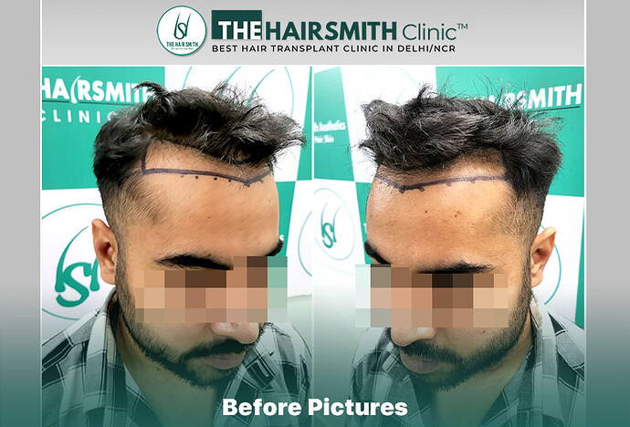 The HairSmith Clinic™ | NW Stage 3 | 1675 Grafts | 9 Months Hair Transplant Result photo