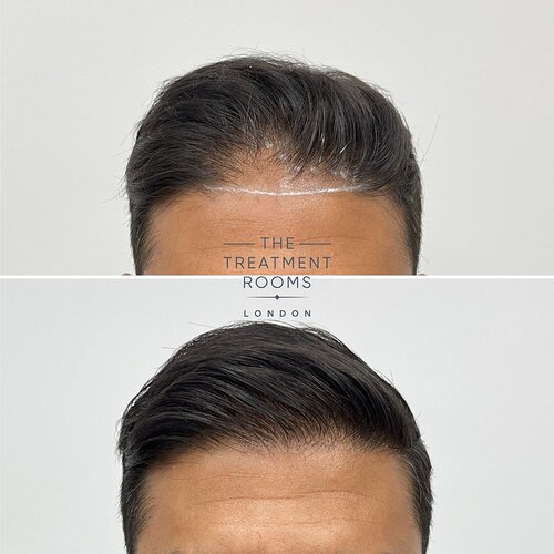 1411 Grafts Hairline and Crown Result- The Treatment Rooms London photo