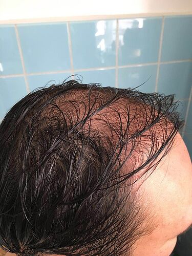 DR HAKAN DOGANAY/4055 GRAFTS/FUE+Implanter Pen photo