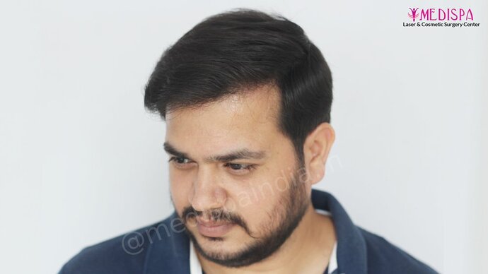 Dr. Suneet Soni - 4937 Grafts, Combine FUT + FUE Technique, NW : IV-V photo