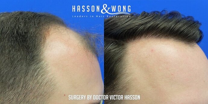 Dr. Hasson / 4,511 grafts / FUE / Frontal zone /mid / 3 years post-op photo