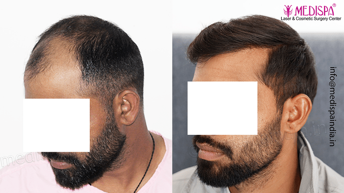 Dr. Suneet Soni - 5360 Grafts | 12-Month Result | Combination FUT + FUE + Beard photo