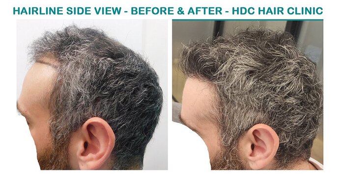 Result of Class 3V Patient – 3530 Grafts – HDC Hair clinic – Dr Maras photo
