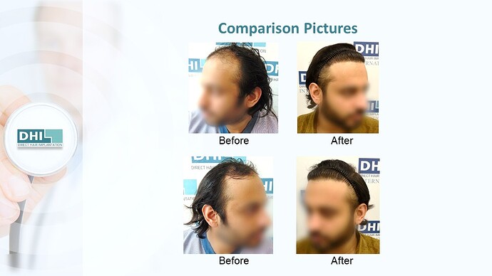 DHI India™ | NW 4 | 3,714 Grafts | 2 Years DHI Hair Transplant Result photo