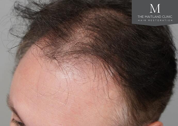 Dr Ball - The Maitland Clinic 2032 Grafts By FUE photo