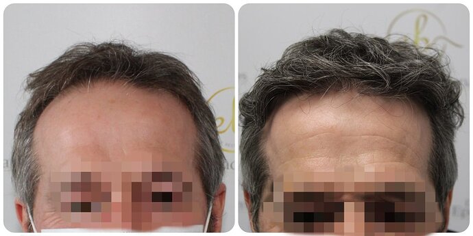 Dr Bonaros, Glasgow, UK / 3595 FUE grafts / 0-12 Months photo