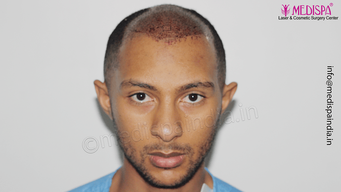 Dr. Suneet Soni - Afro Hair Transplant, 2 Sessions, 8355 Grafts, Combined FUT + FUE Technique, NW-VI, 5 Years Result photo