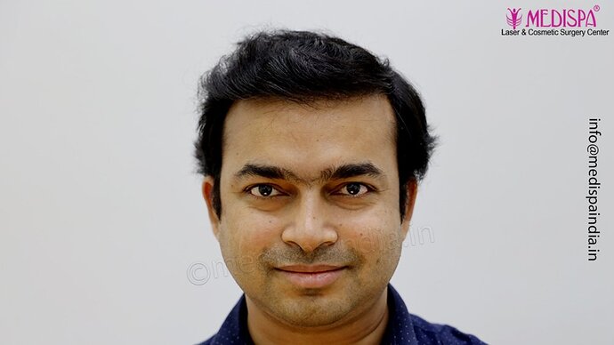 Dr. Suneet Soni - 5000 Grafts, Combine FUT + FUE + Beard Technique, NW-V photo