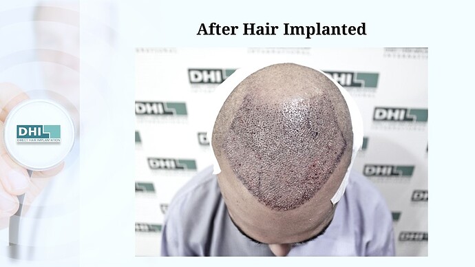 DHI India | NW 6 | 3,460 Grafts | 9-Months DHI Hair Transplant Results photo