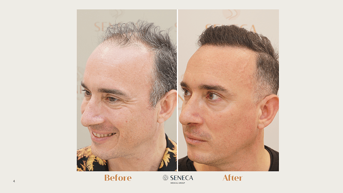 Seneca Medical Group - 4035 grafts with Direct FUE photo
