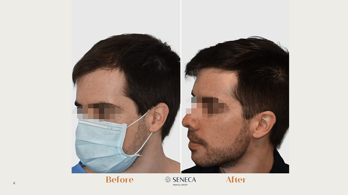 Seneca Medical Group - 746 grafts with Direct FUE photo