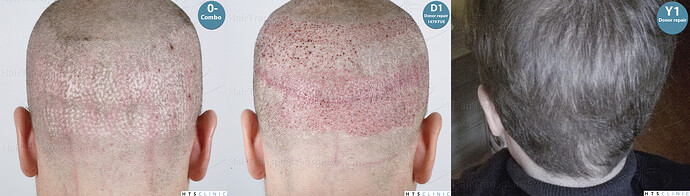 Dr. Jean Devroye, HTS Clinic / Grafts removal + 3936 Combo Repair + 1479 FUE Donor Restocking photo