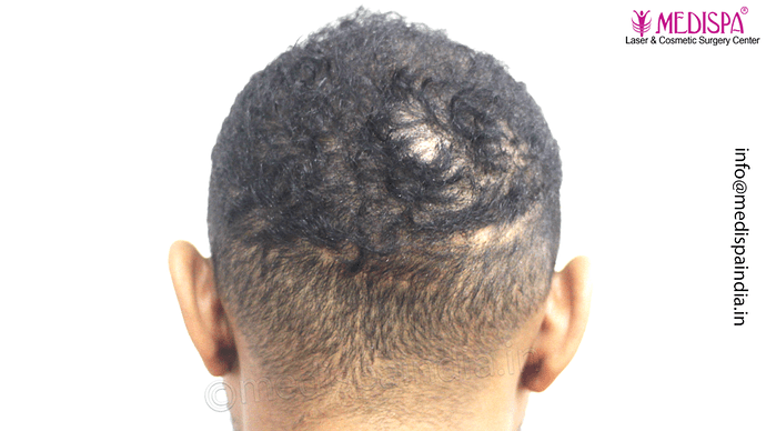 Dr. Suneet Soni - Afro Hair Transplant, 2 Sessions, 8355 Grafts, Combined FUT + FUE Technique, NW-VI, 5 Years Result photo