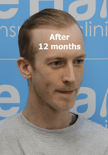 Lee's hair restoration journey - very fine/light hair - Dr Arshad (The Hair Dr Clinic, Leeds, UK) photo