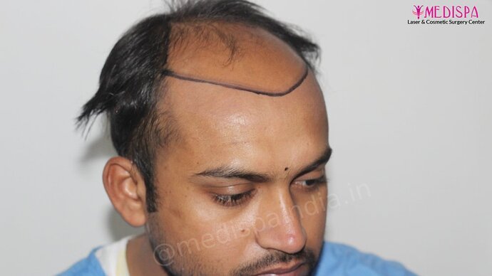 Dr. Suneet Soni - 5587 Grafts, Combine FUT + FUE + Beard Technique, NW : V-VI photo