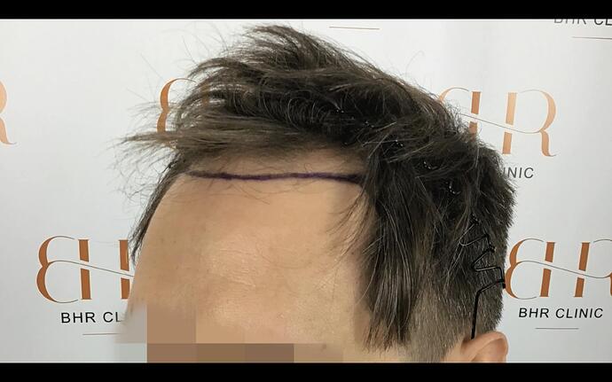 Dr. Bisanga & Dr.Kostis 2903 FUE 0 - 6 Months photo