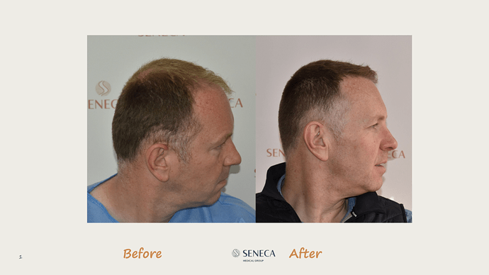 Seneca Medical Group - 3189 grafts with Direct Fue photo