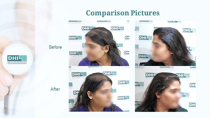 Female Hair Transplant | 1,359 Grafts | 6-Months Result | DHI India™ photo