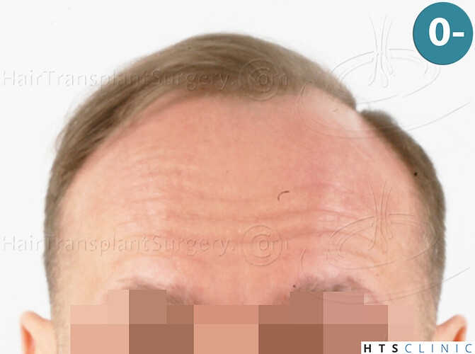 Dr. Jean Devroye, HTS Clinic / 5280 FUE (2008 + 2018 + 1254) / 3 sessions photo