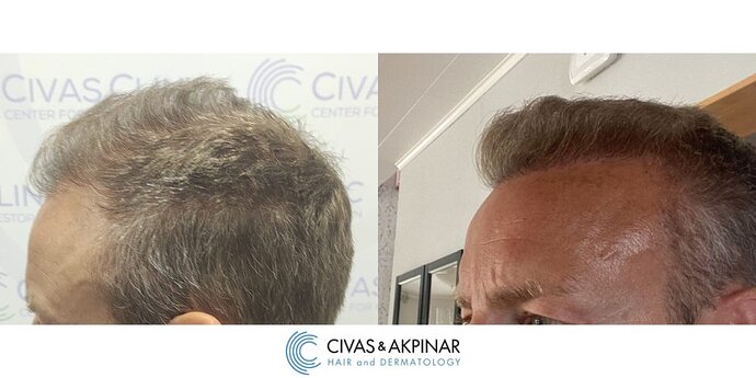 Civas&Akpınar Hair Transplant- FUE Hair Transplant Before & After Pictures (3000 Grafts) photo