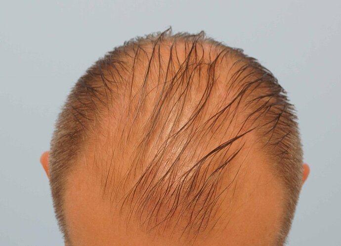 Dr B Farjo 1700g FUE (Front) photo