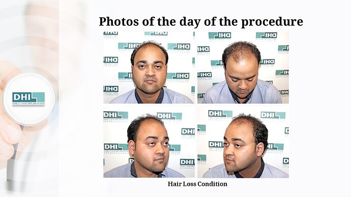 DHI India | NW Scale 5 | 2,923 Grafts | 9-Months DHI Hair Transplant Results photo