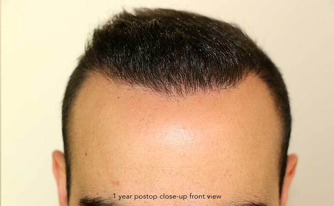 Case performed by Dr. Feriduni – 3505 FU in 1 procedure photo